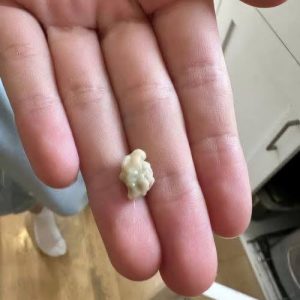 Here’s What You Need to Know About Tonsil Stones